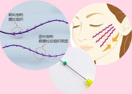 线雕线的种类和区别线雕美容原理和副作用